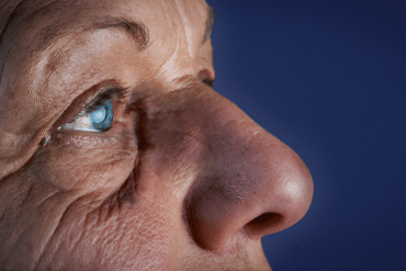 Adult Cataract Surgery in Lahore