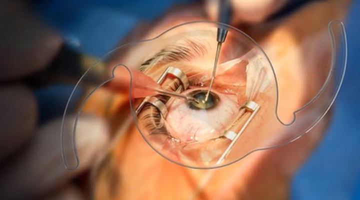 Cataract Surgery in Lahore